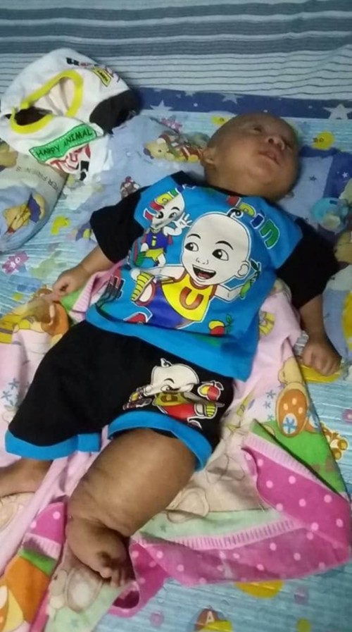 bantu farel operasi kaki besar sebelah dari lahir