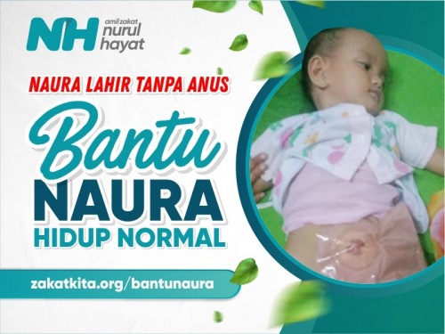 Lahir Tanpa Anus, Bantu Bayi Naura