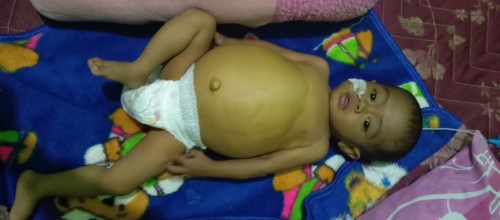 KRITIS!! Empedu Rusak, Abil Butuh Cangkok Hati